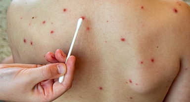 Avrupa'da Kızamık ve Boğmaca Vakaları Alarm Veriyor